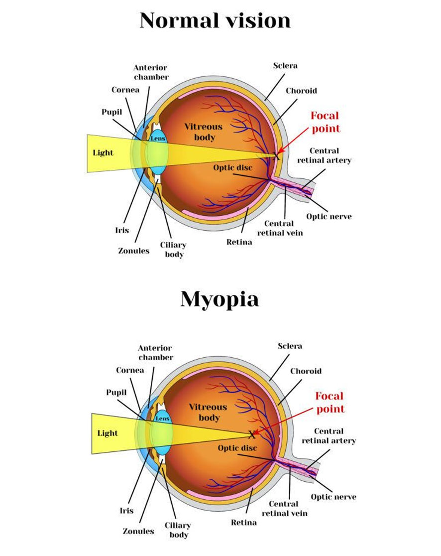 Myopia-Image-3